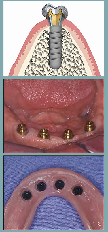 Denture Implants